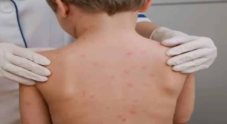 Confirman primeros casos de sarampión en Michoacán